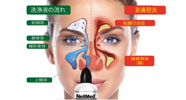 ニールメッド　取り扱い開始　なぜいいの２